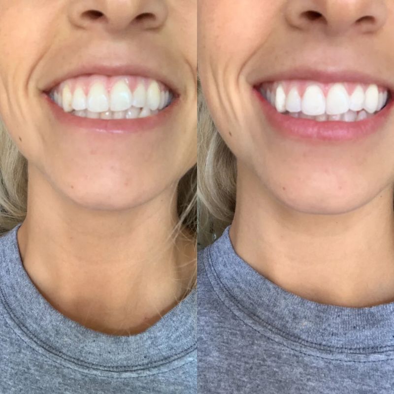 NanoSmile Set