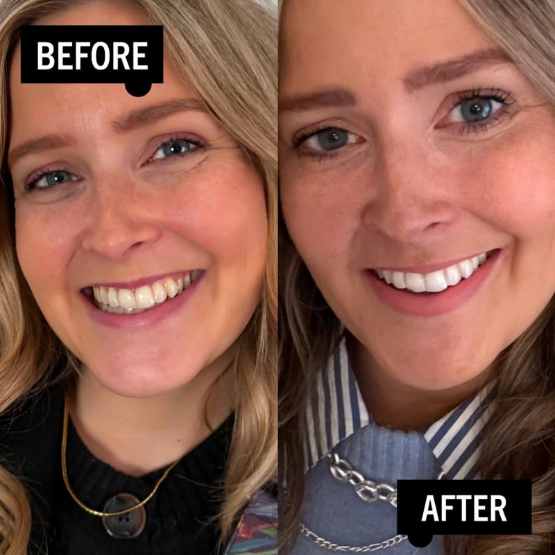 NanoSmile Set