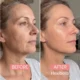 hexibella-004 Collagen Bundle